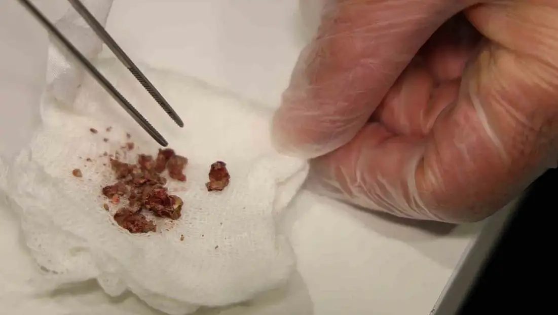 Burun Estetiğinde Taş Çıktı!