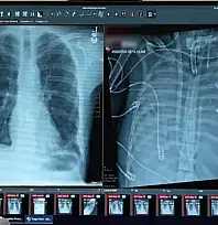 Tıpta Çığır Açan Gelişme: Yapay Akciğerle Hayata Tutundu