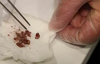 Burun Estetiğinde Taş Çıktı!