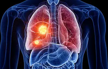 Kadınlarda neden akciğer kanseri artıyor?