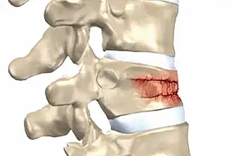 Omurga kırıkları kış aylarında artıyor
