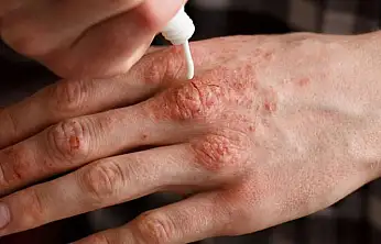 Soğuklarda cilt kuruluğuna karşı 10 tavsiye