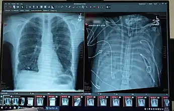 Tıpta Çığır Açan Gelişme: Yapay Akciğerle Hayata Tutundu