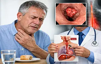 Yemek borusu kanserinin 6 belirtisine dikkat