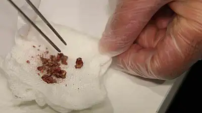 Burun Estetiğinde Taş Çıktı!