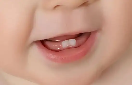 Süt Dişleri Çürüse Ne Olur Demeyin! Uzmandan Uyarılar