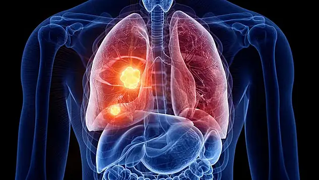 Kadınlarda neden akciğer kanseri artıyor?