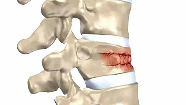 Omurga kırıkları kış aylarında artıyor