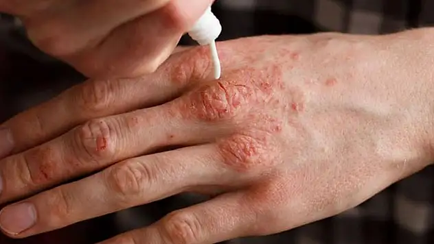 Soğuklarda cilt kuruluğuna karşı 10 tavsiye