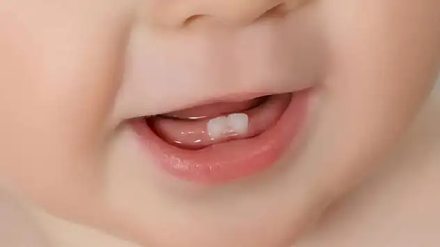 Süt Dişleri Çürüse Ne Olur Demeyin! Uzmandan Uyarılar