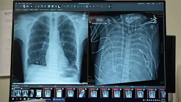 Tıpta Çığır Açan Gelişme: Yapay Akciğerle Hayata Tutundu