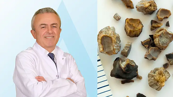 Yetersiz su tüketimi böbrek taşına yol açabiliyor