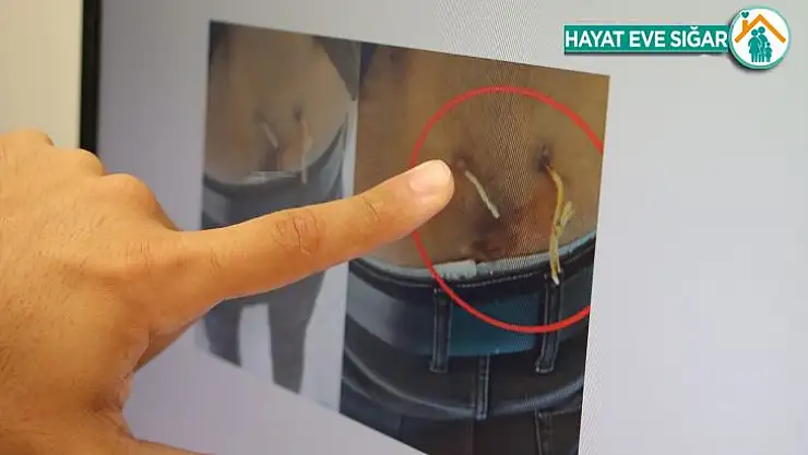 Ağrıları geçsin diye belinden çamaşır ipi geçirmişler