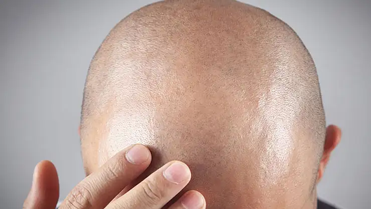 Hindistan'da Yeni Virüs Alarmı 155 Kişi Aniden Kel Kaldı