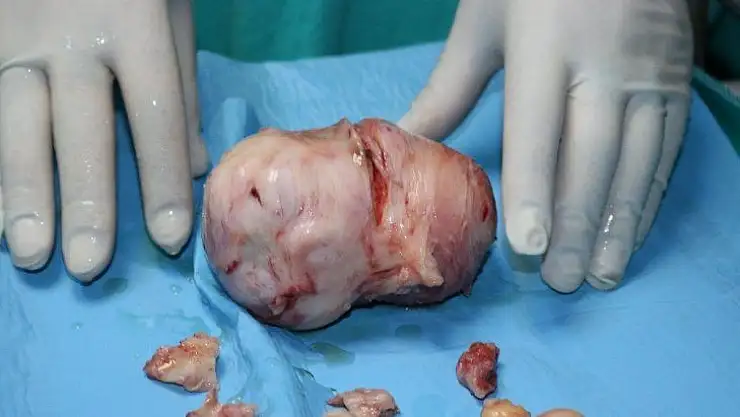 Karnından 15 santimlik miyom çıktı