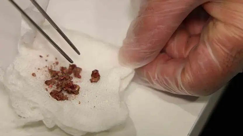 Burun Estetiğinde Taş Çıktı!