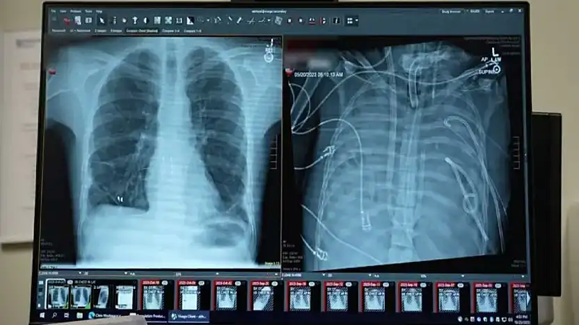 Tıpta Çığır Açan Gelişme: Yapay Akciğerle Hayata Tutundu