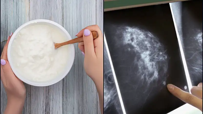 Yoğurt tüketimi meme kanserine karşı koruyucu olabilir mi?