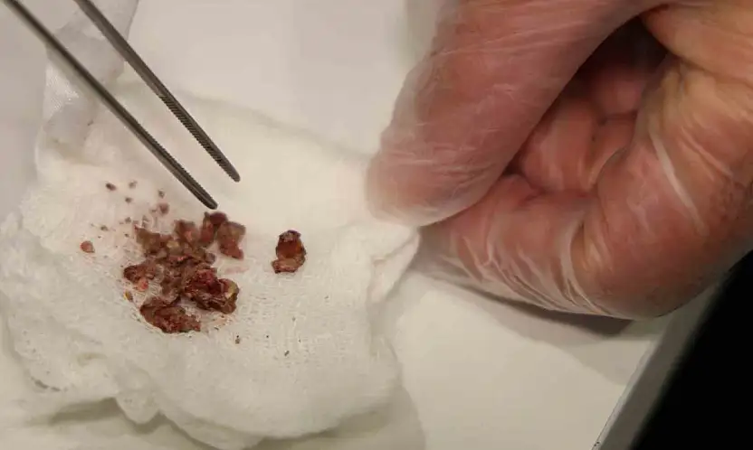 Burun Estetiğinde Taş Çıktı!