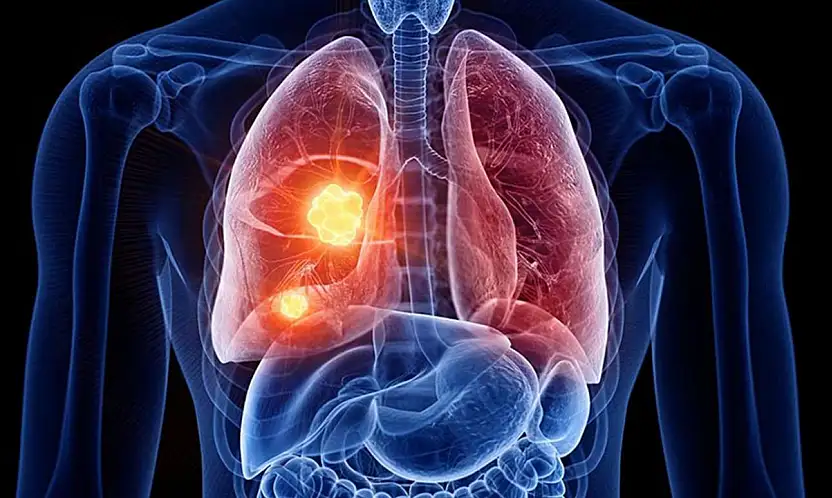 Kadınlarda neden akciğer kanseri artıyor?