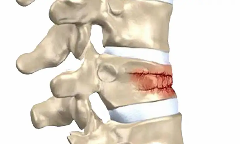 Omurga kırıkları kış aylarında artıyor