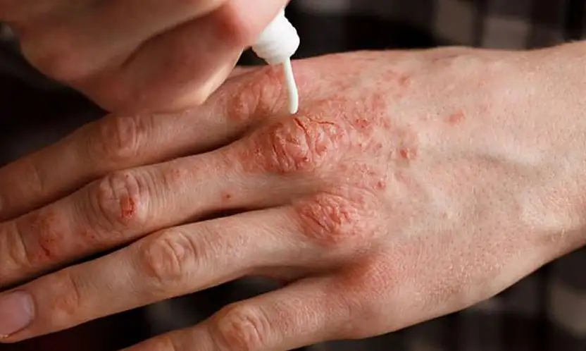 Soğuklarda cilt kuruluğuna karşı 10 tavsiye