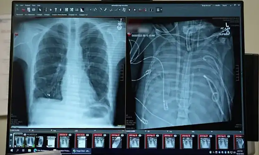 Tıpta Çığır Açan Gelişme: Yapay Akciğerle Hayata Tutundu